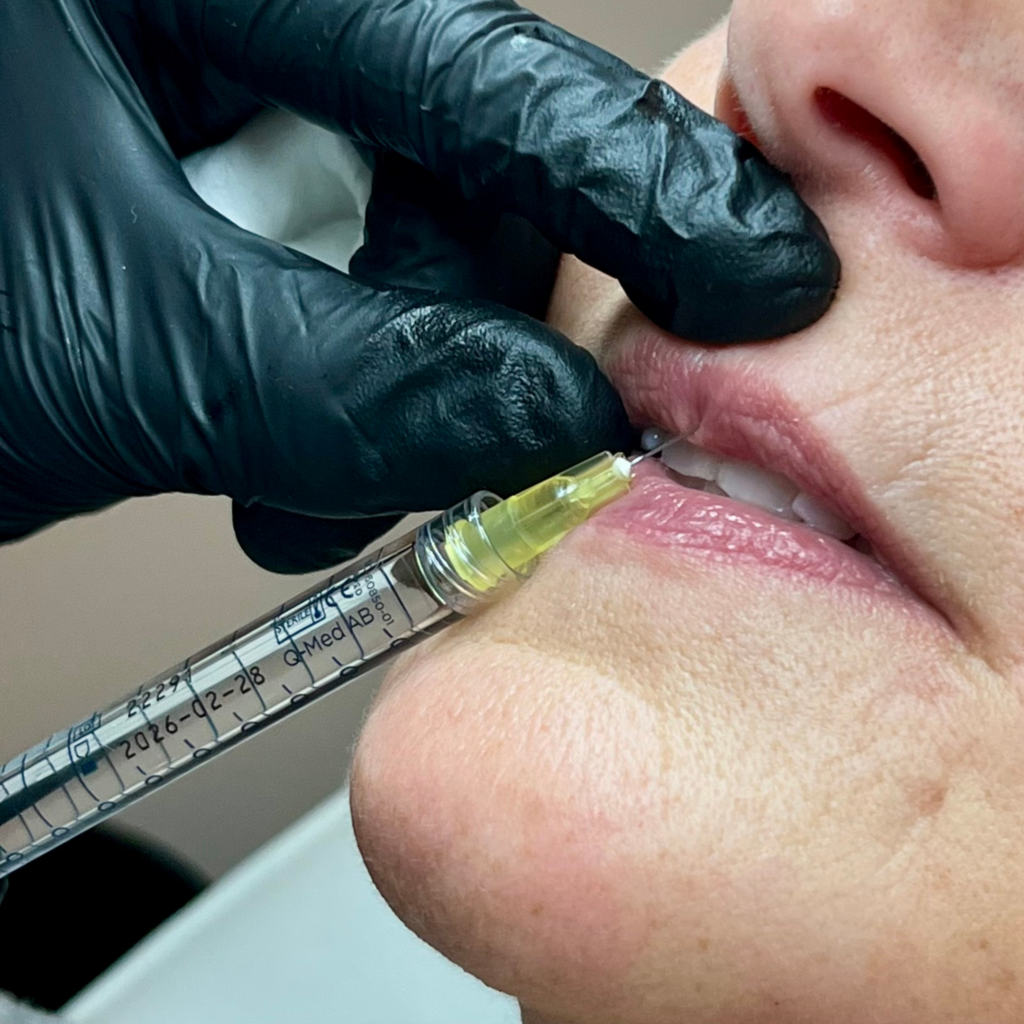 Lipfiller behandeling bij vrouw door cosmetisch arts