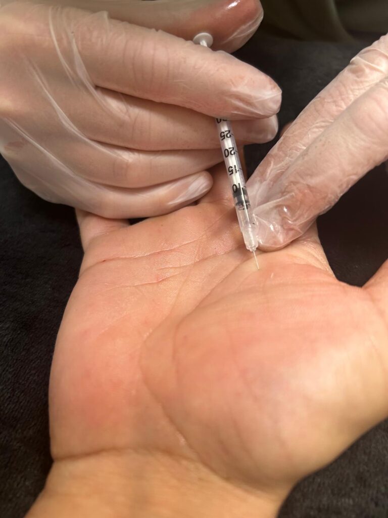 Botuline toxine behandeling bij hyperhidrose (zweethanden)